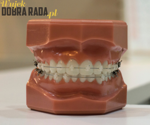 Jakie są rodzaje stałych aparatów ortodontycznych?